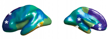 Altered asymmetry of cerebral cortex thickness in autism spectrum disorder. The stars show the affected brain regions.