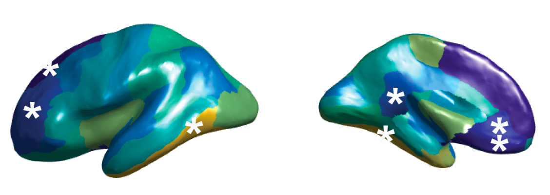 Altered asymmetry of cerebral cortex thickness in autism spectrum disorder. The stars show the affected brain regions. Thumbnail